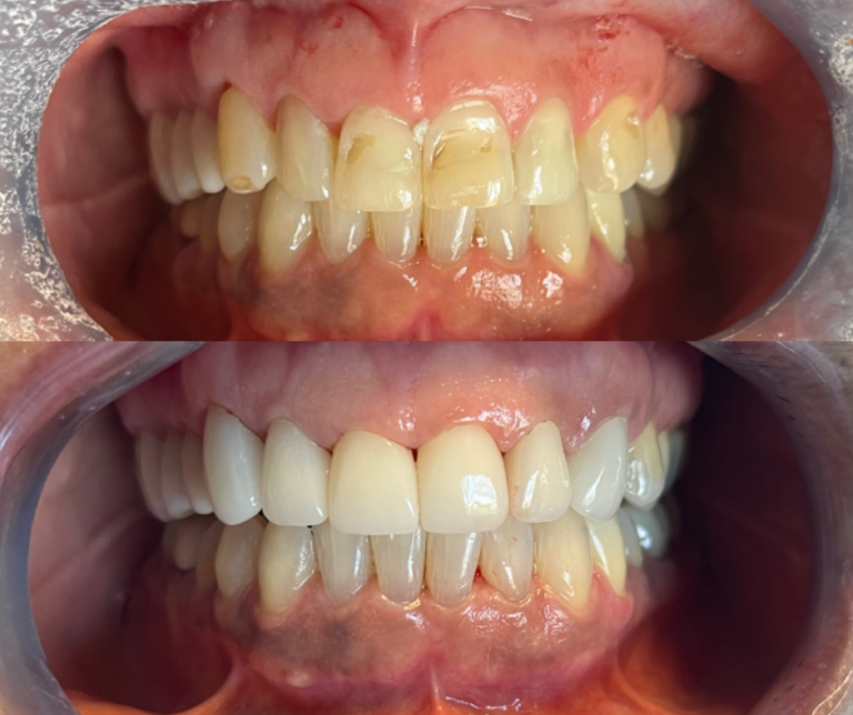 Before and After Dental Implants Example #5