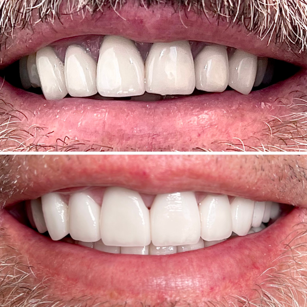 Before and After Dental Implants Example #7