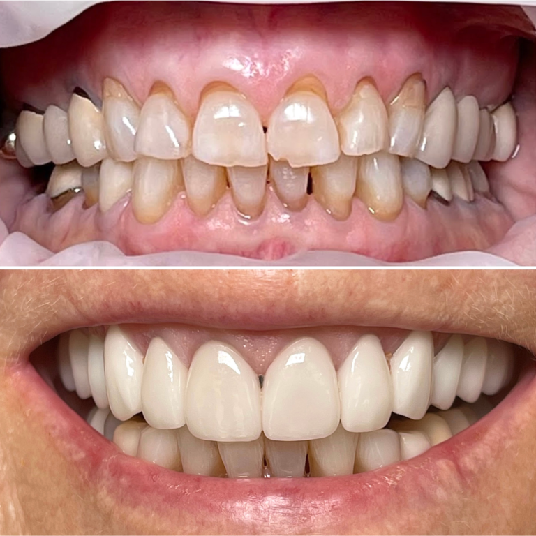 Before and After Dental Implants Example #2