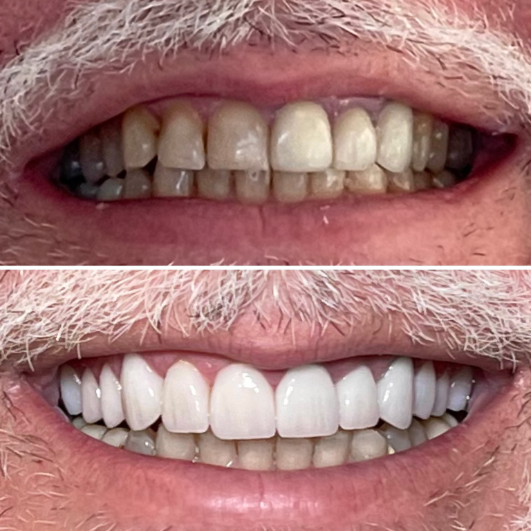 Before and After Dental Implants Example #3