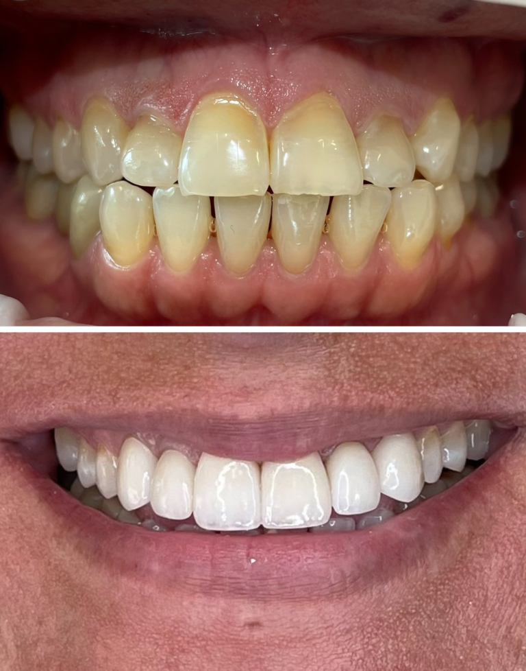 Before and After Dental Implants Example #6