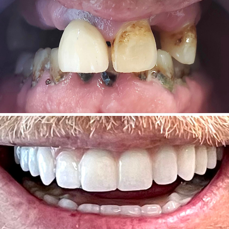 Before and After Dental Implants Example #1