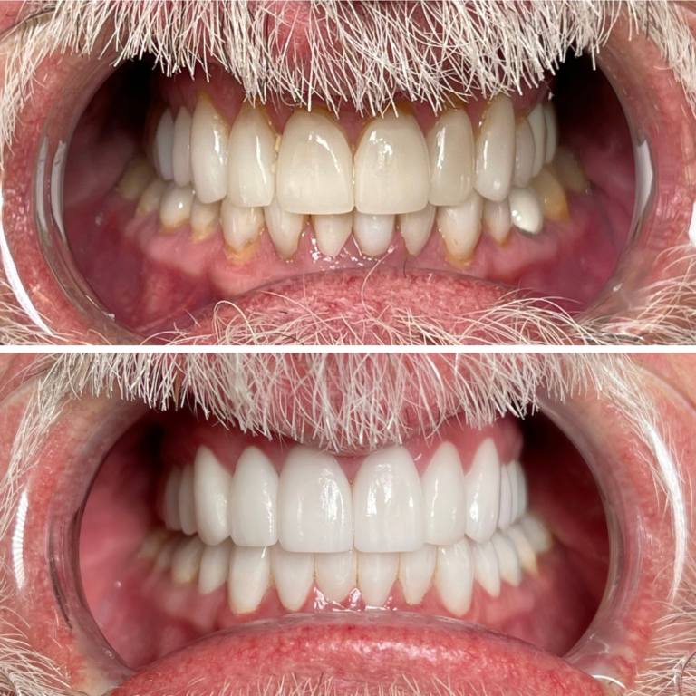 Before and After Dental Implants Example #4