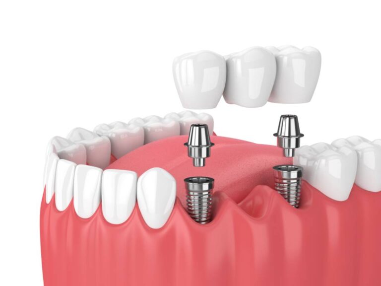 Removable vs Non-Removable Dental Implants: Making the Right Choice