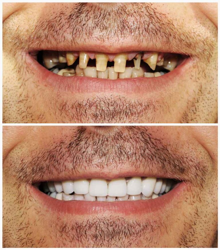 Full Mouth Reconstruction Process: From Consultation to Completion