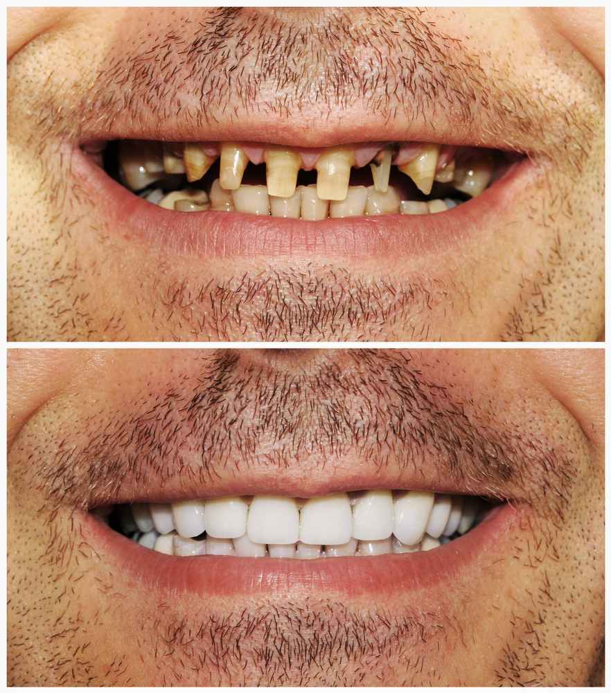 Photo of a man who received a full mouth restoration